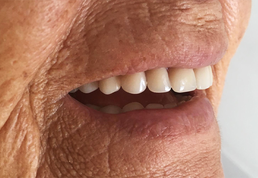Prótesis Dentales